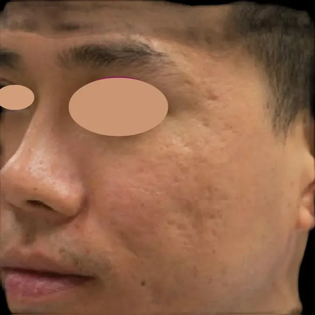 After: microneedling with PRP for acne scars