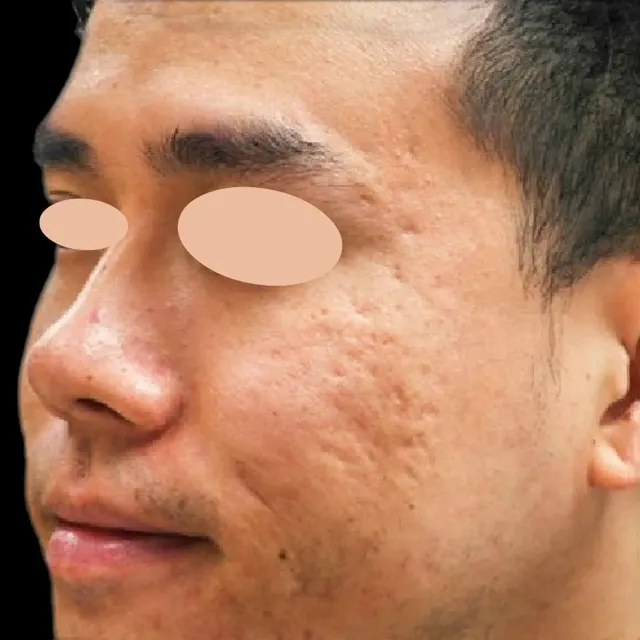 Before: microneedling with PRP for acne scars