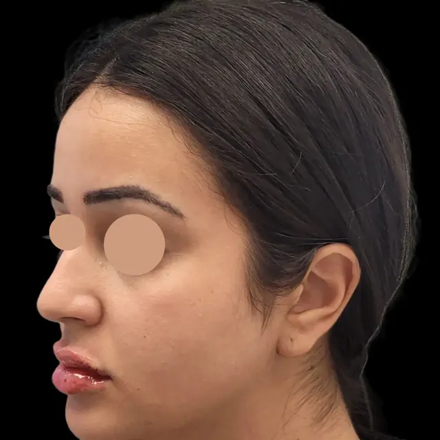After: lip filler, side view