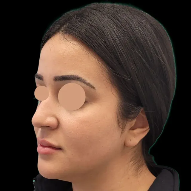 Before: lip filler, side view