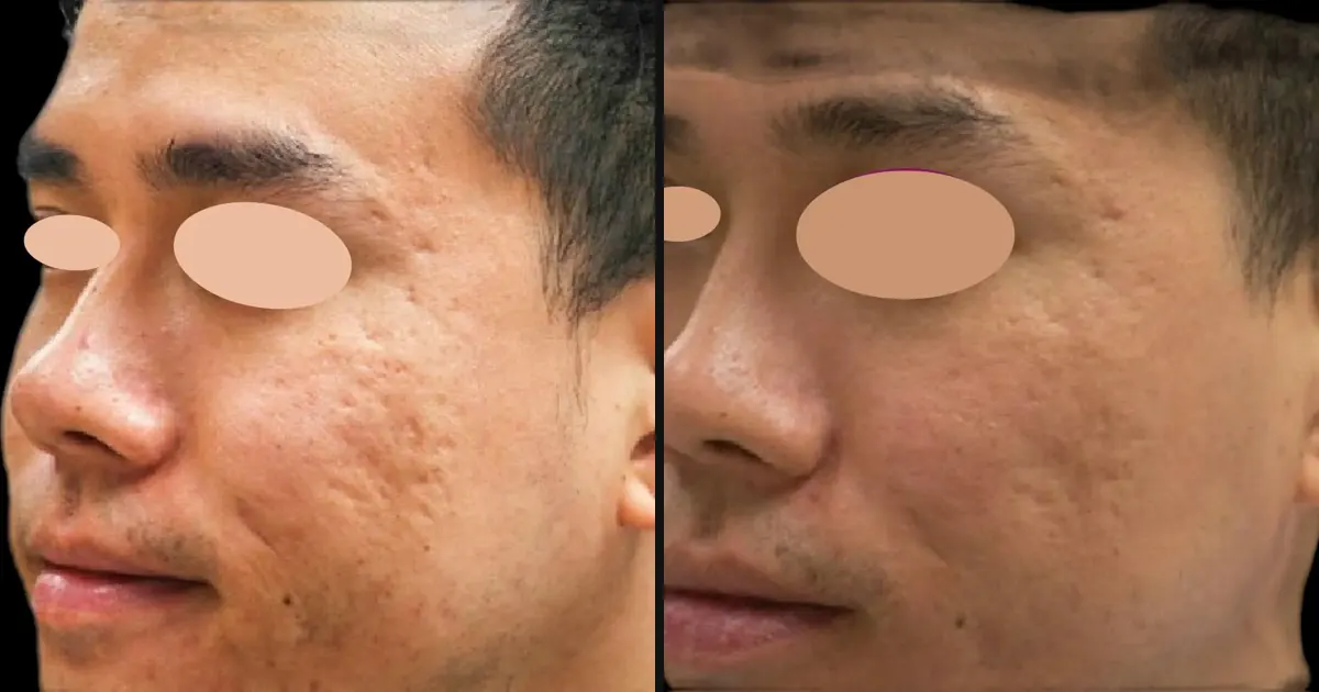 Microneedling vs OxyGeneo Facial: Which One Does Your Skin Need?