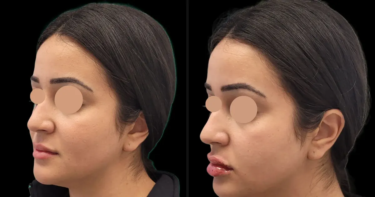 Lip Filler for the First Time: What to Expect, Day by Day