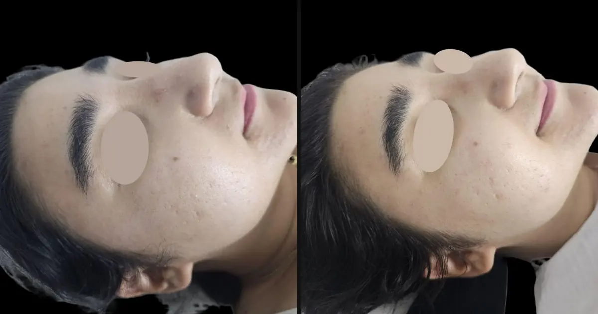 Can You Get a Facial With Lash Extensions? How to Protect Your Set